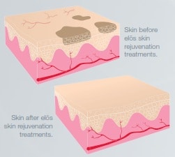 Advanced Skin Rejuvenation & IPL - Healthy Skin Centre